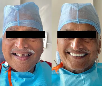 Full Arch Rehabilitation and implant case study at CTOMATODONT Dental Care