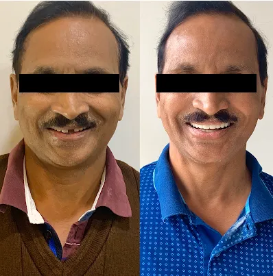 Anterior gap closure diastema case study at CTOMATODONT Dental Care